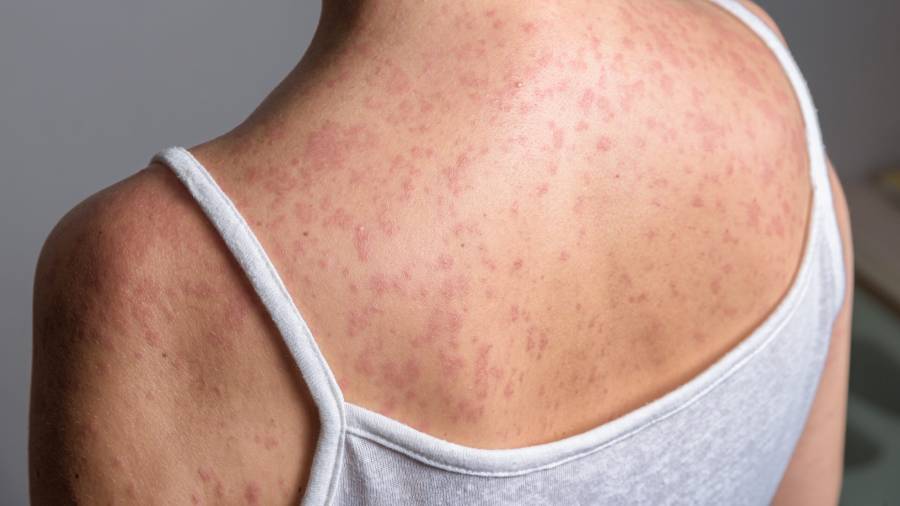 Espalda y hombro de una persona con un sarpullido de manchas rojas